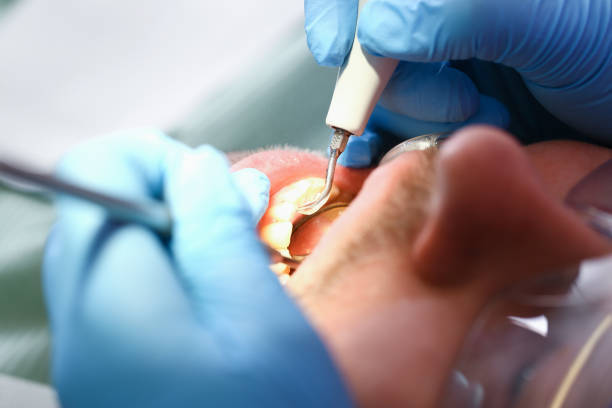 Best Emergency Treatment for Toothache in Milan, IN